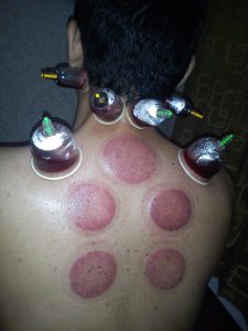 RecoverFun AirCup Prime Review - cupping example - original source: google images